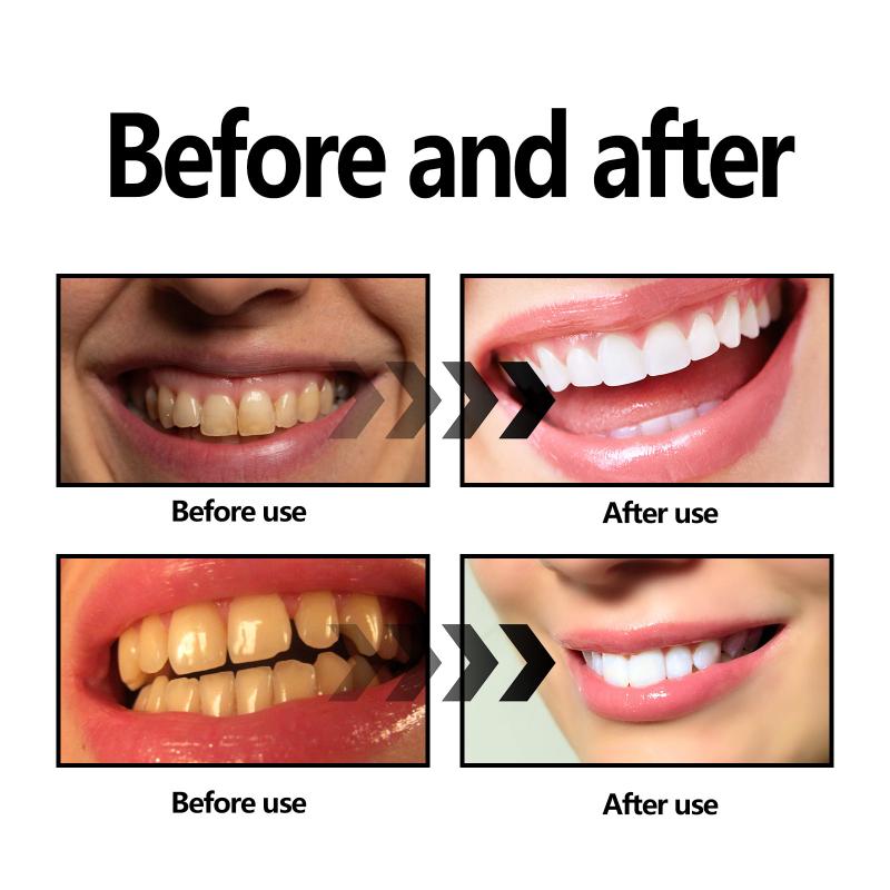 치아 미백 파우더 숯/베이킹 소다 치아 미백 파우더,  - Teeth Whitening With Baking Soda 리뷰 및 가격