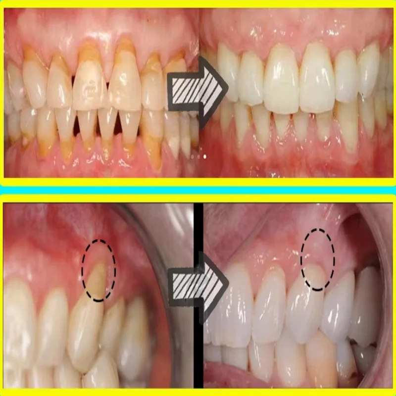 치약 세럼으로 빠르게 치아 주위 조직 회복, 치아 미백 - Teeth Whitening With Baking Soda 리뷰 및 가격