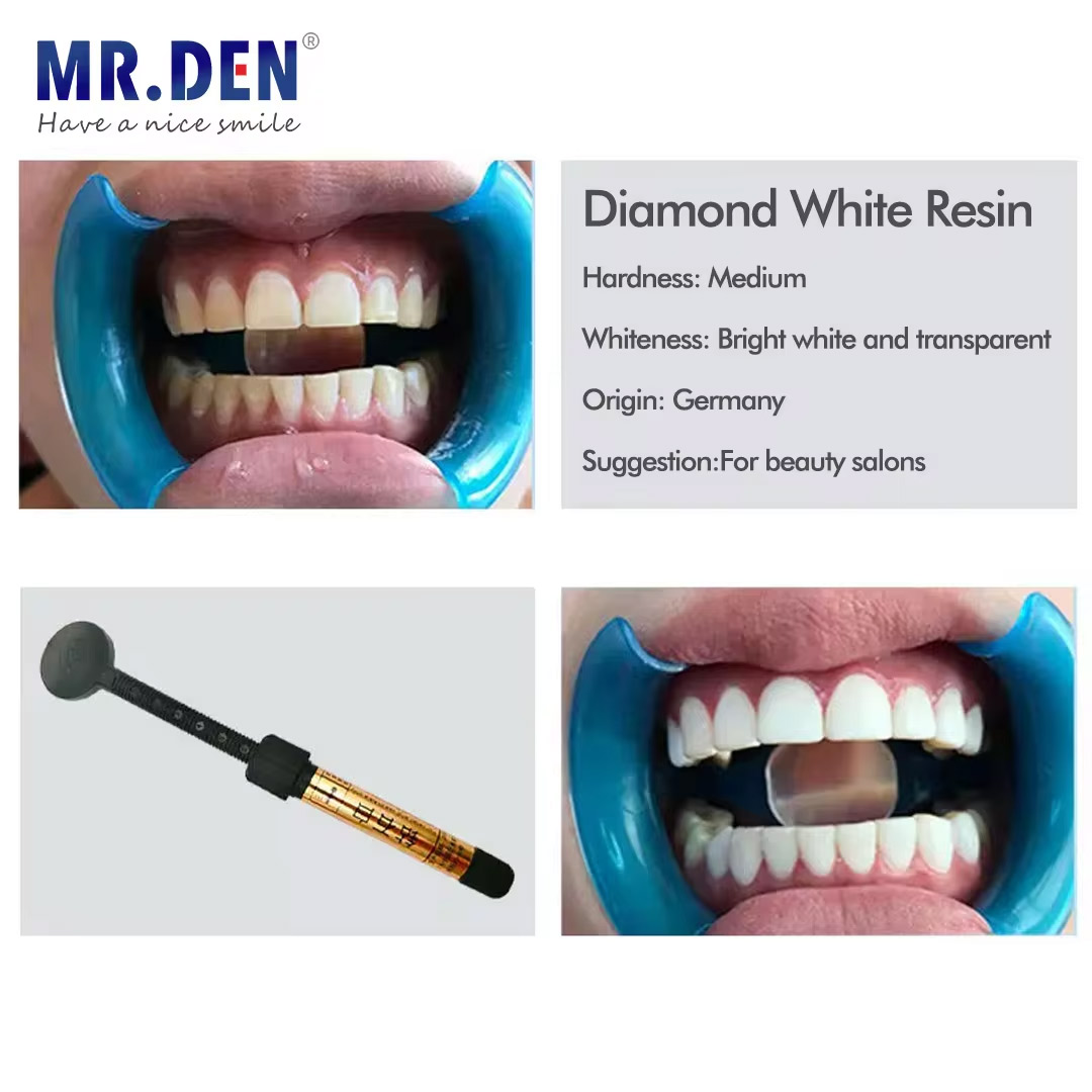 나노 에나멜 베니어 재료 치아 미백 광중합 레진 이보클 - Teeth Whitening Veneers 리뷰 및 가격
