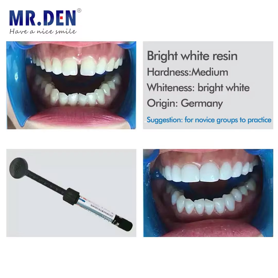 나노 에나멜 베니어 재료 치아 미백 광중합 레진 이보클 - Teeth Whitening Veneers 리뷰 및 가격