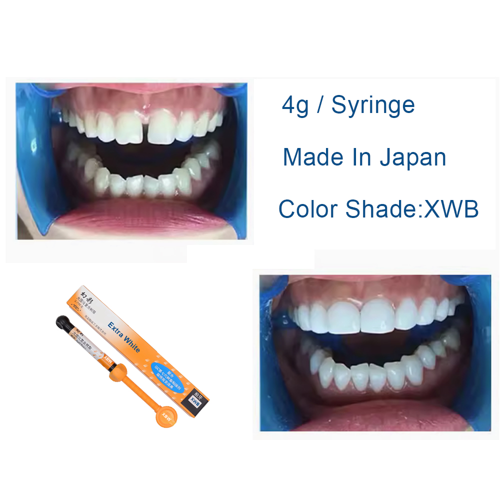 치과용 복합 레진 엑스트라 화이트 XBW BW 뷰티 블 - Teeth Whitening Veneers 리뷰 및 가격